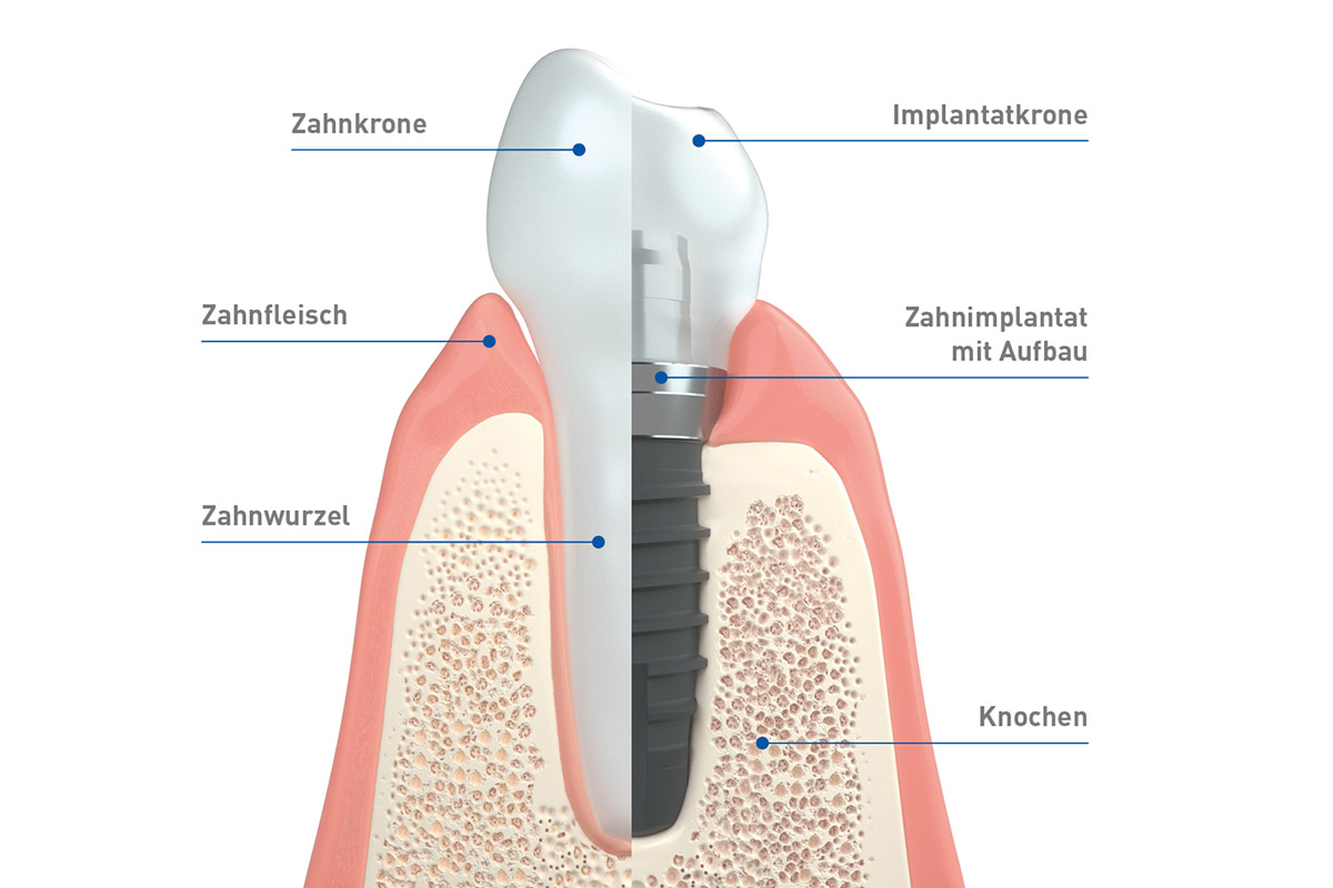 2023 05 08 natur nahe implantate 03